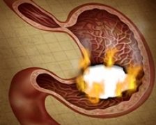 Gastrita si colita: doua dintre cele mai comune tulburari digestive