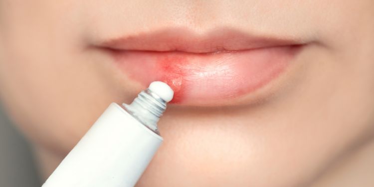 ce este herpesul bucal, herpes bucal simptome, cauze herpes bucal, factori deris pentru herpesul bucal, diagnostic herpes bucal, sfaturi pentru a preveni aparitia herpesului bucal, 