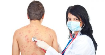 Zona Zoster, contagioasa si dureroasa