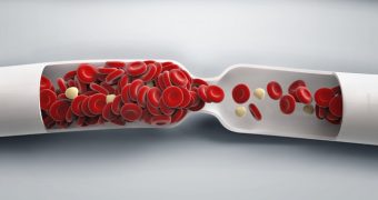 Cheagurile de sange: care sunt simptomele si factorii de risc?