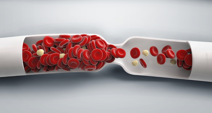 Cheaguri de sange: care sunt simptomele si factorii de risc?
