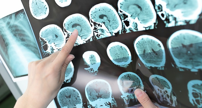 Cum este afectat creierul dupa traumatismele craniene