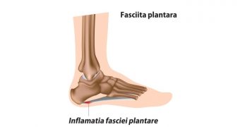 Fasciita plantara: remedii pentru acasa