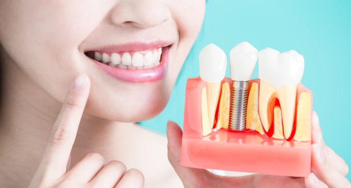 6 intrebari si raspunsuri despre implantul dentar