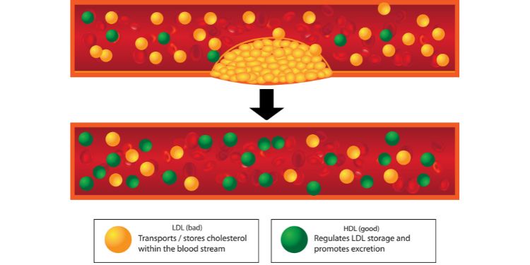 HDL vs. LDL, colesterol rau vs colesterol bun,