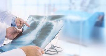 Emfizemul pulmonar: simptome si tratament
