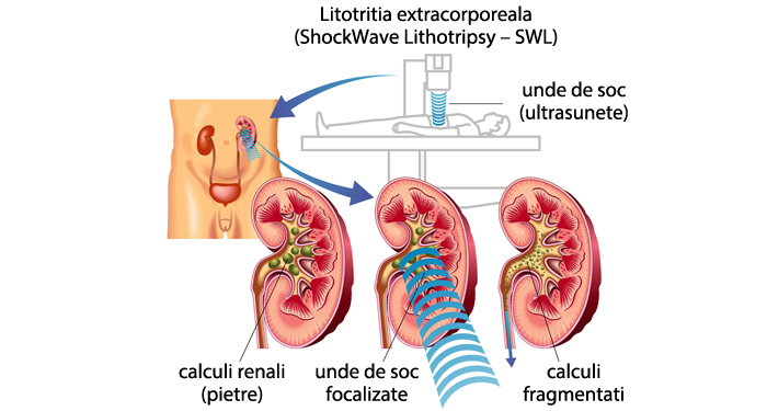 Extracorporeal-shock-wave-lithotripsy-OK