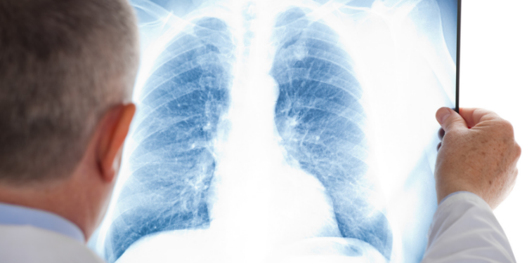 Durere în plămâni (durere pulmonară) | Cauza, diagnostic, simptome și tratament