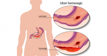 Ulcerul hemoragic: simptome si tratament
