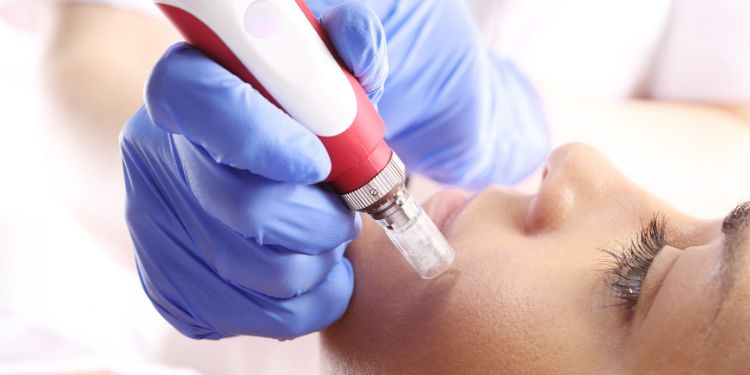 hiperpigmentare, terapie laser,