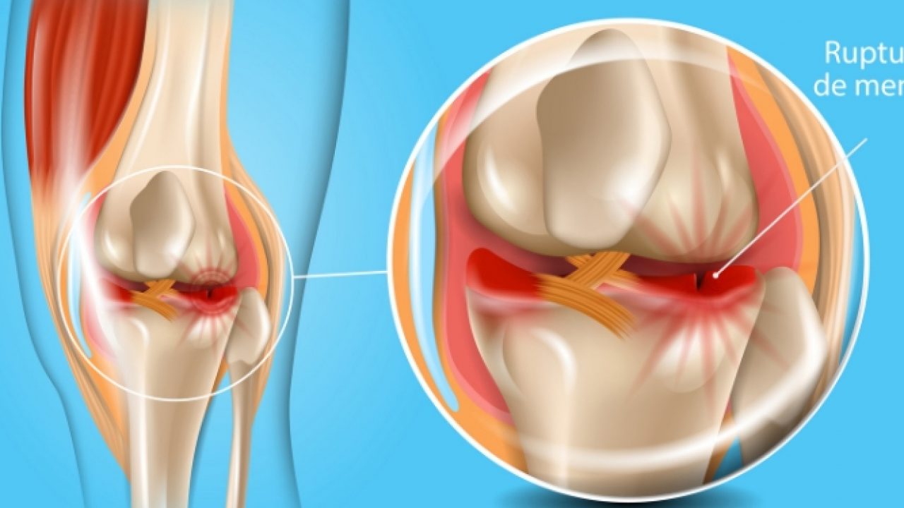 Rupturile de menisc – diagnostic și tratament | Arcadia Spitale si Centre Medicale