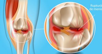 Ruptura de menisc: cauze, simptome, tratament