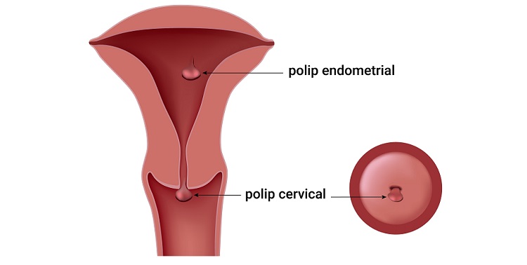 suspiciunea de polip endometrial
