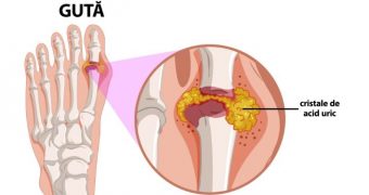 Guta: cauze, simptome, tratament