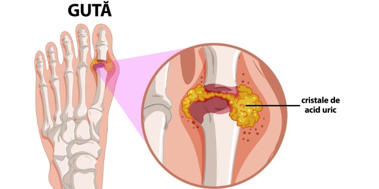despre guta simptome ce este cu artroza articulațiilor