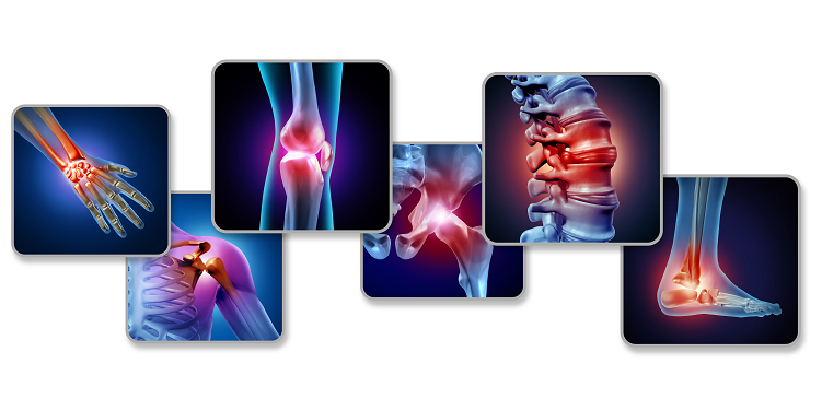 Osteofitoza: cauze, simptome, tratament