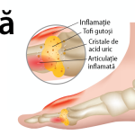 simptomele și tratamentul osteocondrozei)