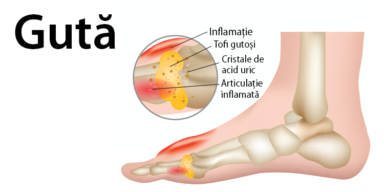tratament guta cu colchicina artroza deformantă a tratamentului chirurgical al genunchiului