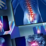 Lamei umărului osteocondroza