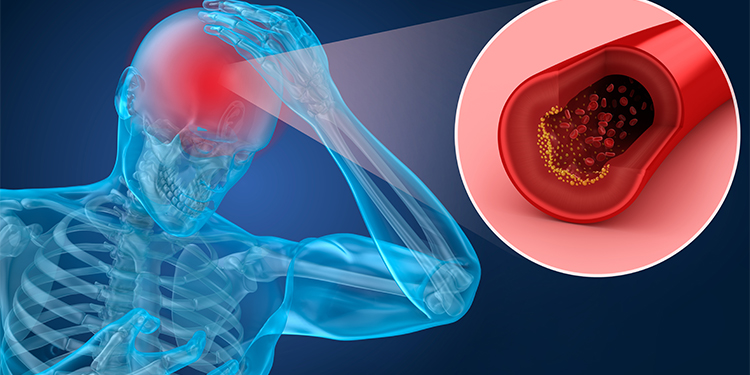 accident vascular cerebral AVC