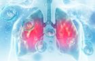 Legătura dintre cheagurile de sânge şi cancerul pulmonar