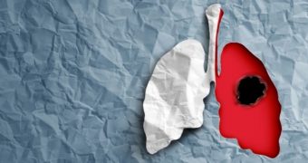 Cancerul pulmonar, „inamicul” oncologic numărul 1