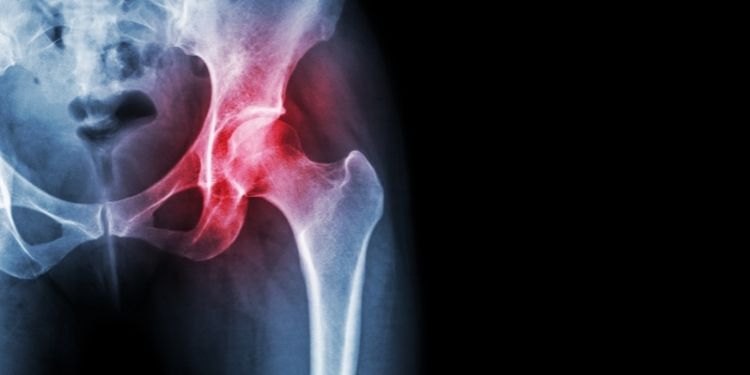 osteoartrita subtalară durere de șold stâng