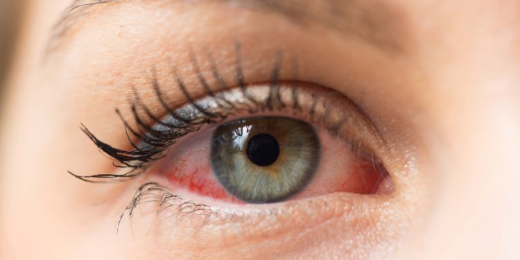 alergie oculara, ce este o alergie oculara, alergie oculara simptome, ce solutii exista pentru alergie oculara, alergie oculara principalii alergeni, alergie oculara sau conjunctivita, alergie oculara diagnostic si tratament, lentilele de contact si alergiile oculare, alergie oculara ce sa nu faceti cand va mananca sau ustura ochii, alergia oculara afecteaza vederea, complicatiile unei alergii oculare, sfaturi alergie oculara, 