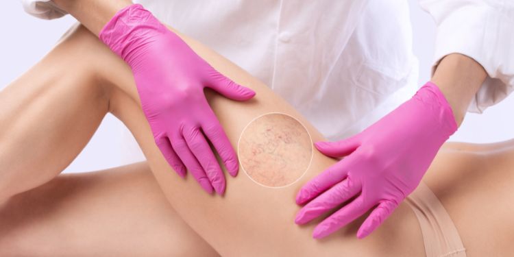 Diolex Gel, Diolex comprimate, hemoroizi, de sindromul picioarelor „grele”, fragilitate capilară, Diolex,