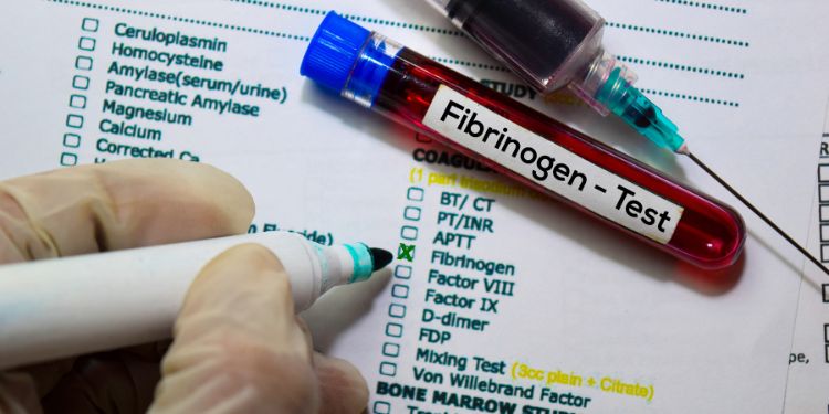 fibrinogen crescut, fibrinogen, fibrinogen scăzut,