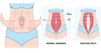 Diastaza abdominală – cauze, simptome, management
