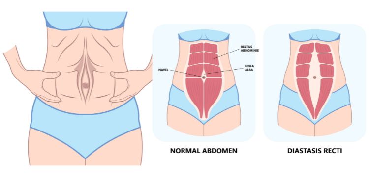 diastaza abdominală, linia alba, mușchi,