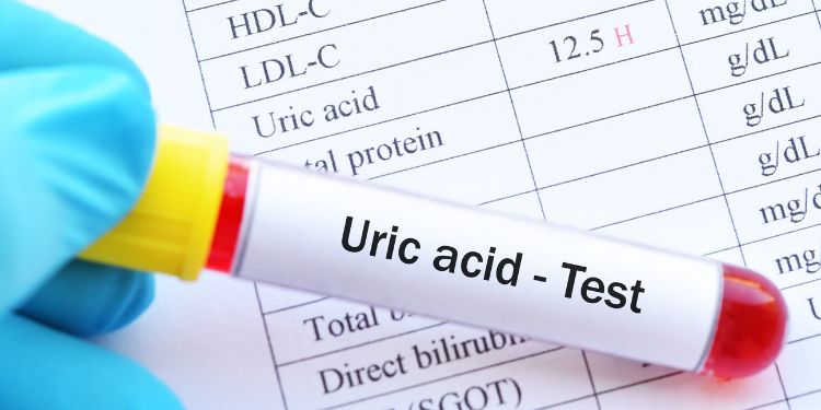 acid uric, acidul uric, rinichi, acid uric crescut,