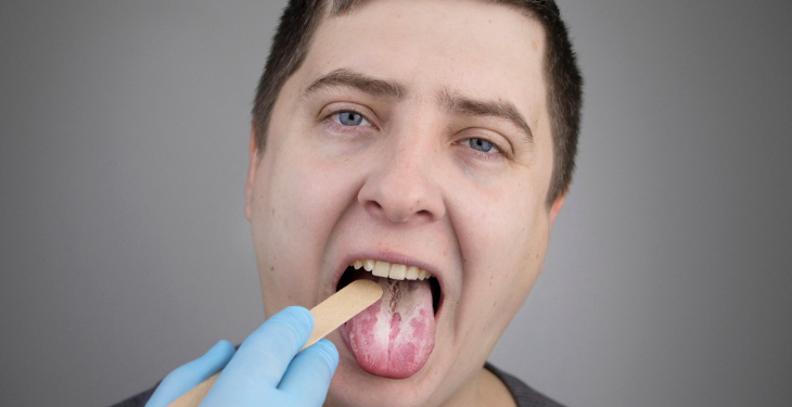 cauze limba alba, despre leucoplazia orala, pete albe pe limba, tratament limba alba, remedii limba alba, 