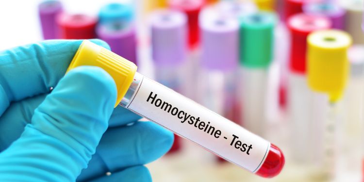 Homocisteina, indicator precoce în detectarea riscului de boli cronice
