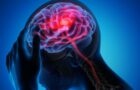 7 mituri despre accidentul vascular cerebral (AVC)