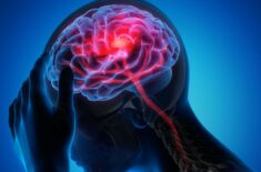 7 mituri despre accidentul vascular cerebral (AVC)