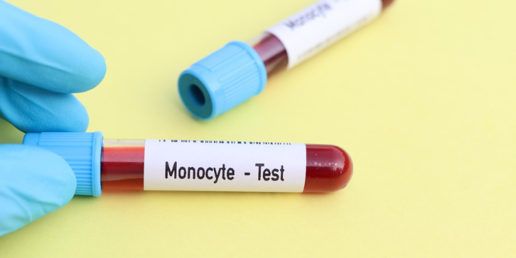 monocitoza, monocite crescute, valori normale monocite, valori crescute monocite, interpretare analize monocite, tratament monocite crescute, diagnostic monocite crescute, 