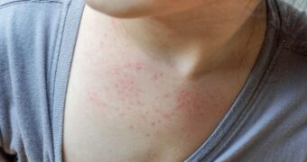 Roseola infantum: cauze, simptome și tratament