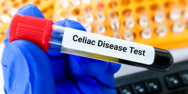 test boala celiacă,