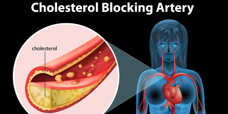 statine, colesterol, colesterol LDL, colesterol HDL, colesterol rau, colesterol bun, colesterol marit, hipercolesterolemie, scaderea colesterolului, 