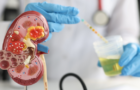Mucus în urină – cauze, afecțiuni asociate și opțiuni de tratament