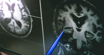 Lacunarism cerebral: cauze, simptome, diagnostic și tratament