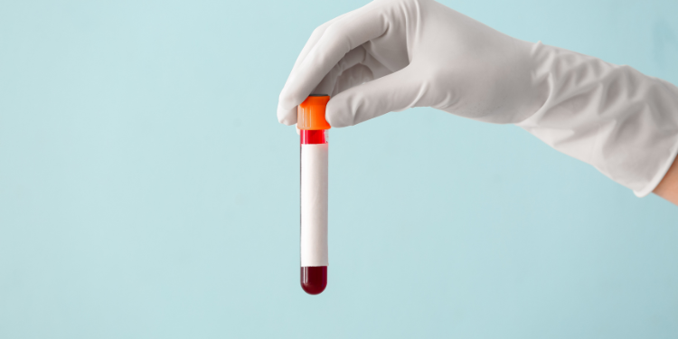 pdw scazut, pdw mic, ce inseamna pdw, interpretare analiza pdw, infectie hiv, trombocite, 