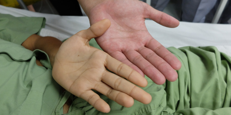 hiperbilirubinemie, bilirubina directa crescuta, bilirubina crescuta, afectiuni, diagnostic, analiza, analize,
