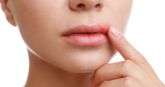 Herpes bucal – informații medicale, tratament, riscuri asociate