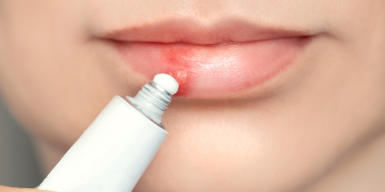 herpes bucal, simptome herpes, cum arata herpes, cauze herpes, tratament herpes,