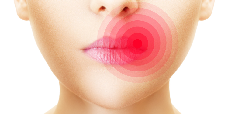 herpes bucal, simptome herpes, cum arata herpes, cauze herpes, tratament herpes,