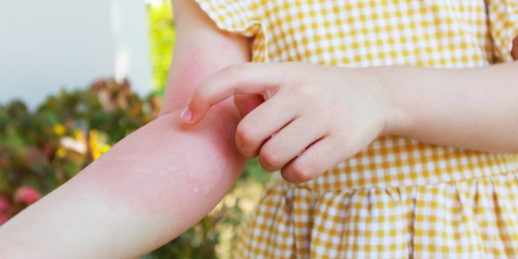 de ce apare urticaria la copii, ce este urticaria, cum se pune diagnosticul de urticarie copii, urticarie copii cauze posibile, urticarie copii ce puteti face acasa, urticaria la copii cand sa mergeti la medic,