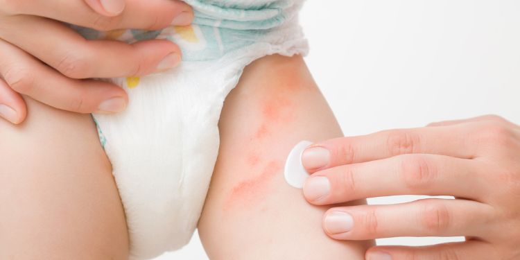 de ce apare urticaria la copii, ce este urticaria, cum se pune diagnosticul de urticarie copii, urticarie copii cauze posibile, urticarie copii ce puteti face acasa, urticaria la copii cand sa mergeti la medic,